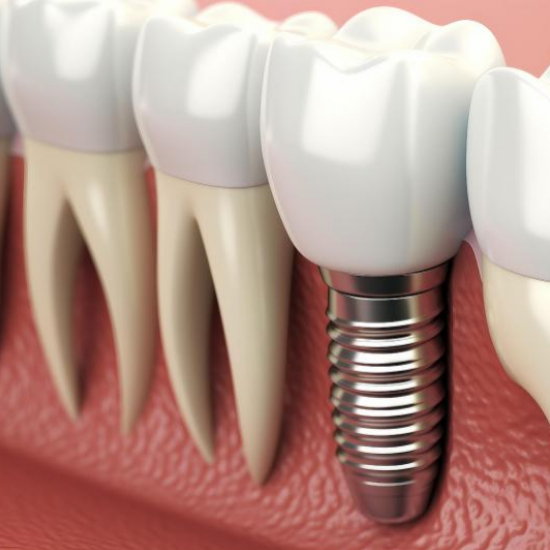 임플란트 시술 비용과 보험 적용 범위1