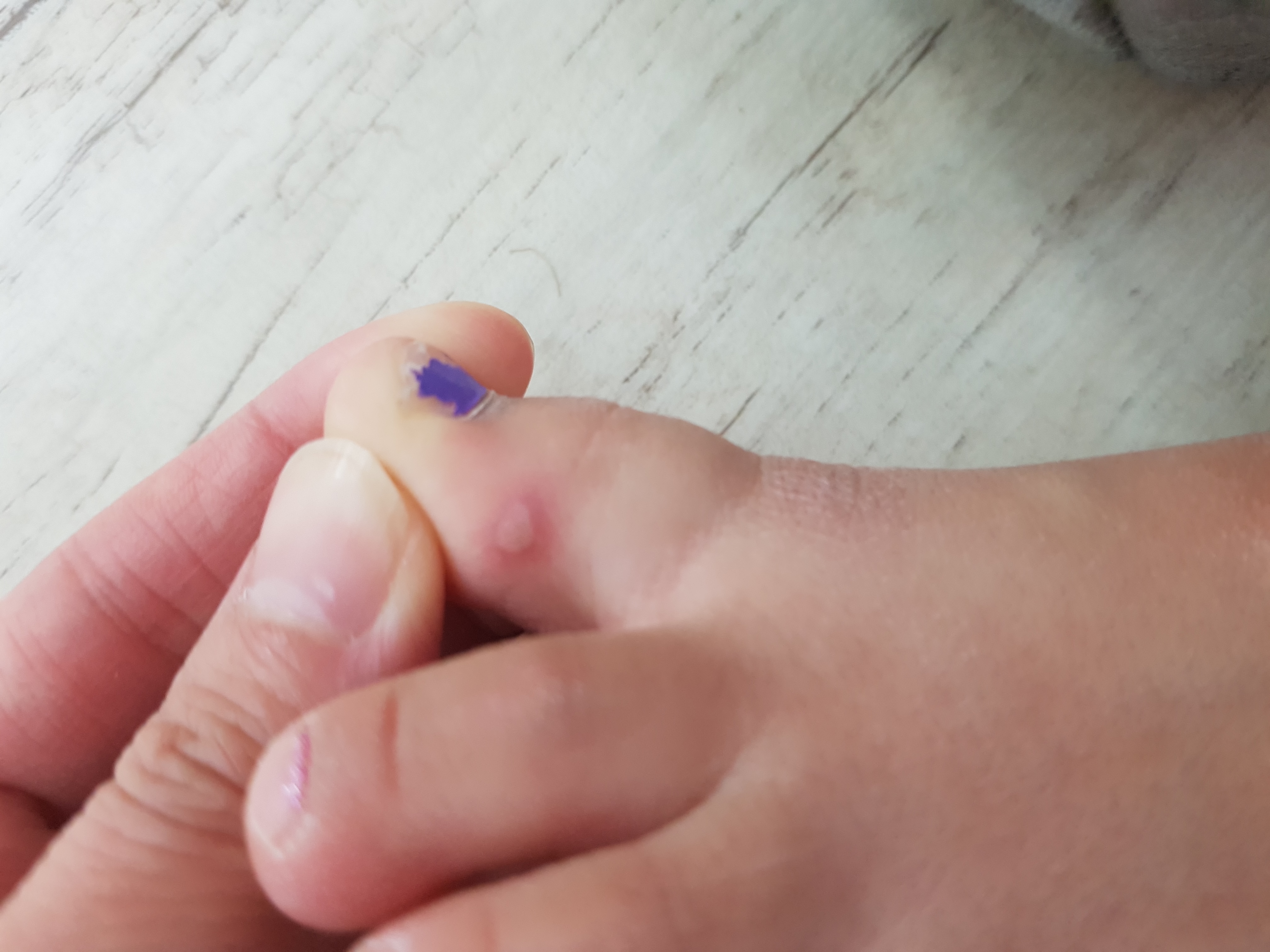 chickenpox symptoms 1