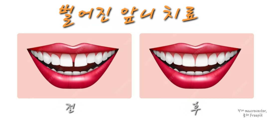 벌어진 앞니 치료 전 후