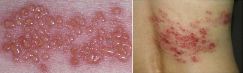 대상포진 초기증상