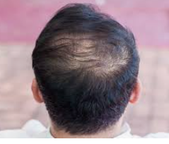 미녹시딜 부작용