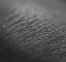 두드러기 치료방법 진단 기준 합병증