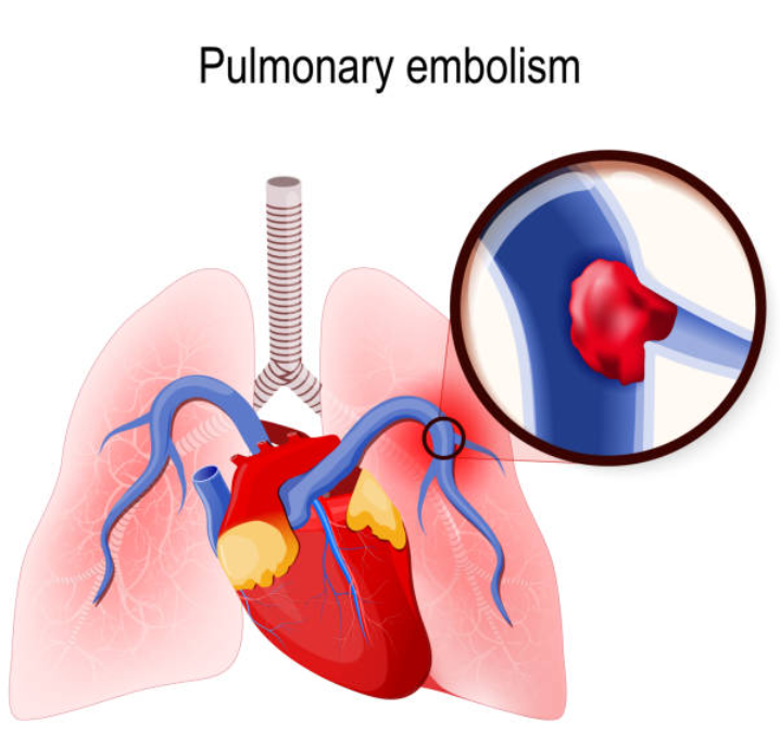 폐색전증과 관련된 사진2