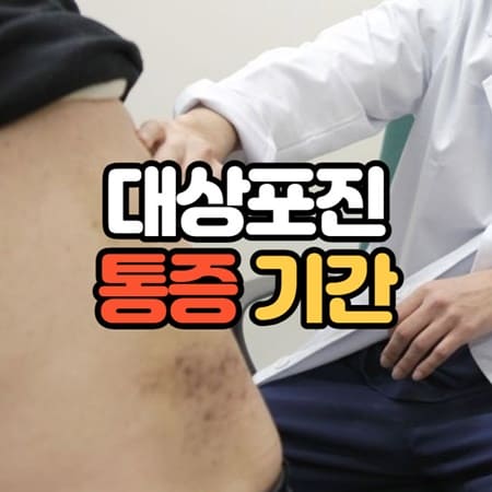 대상포진 통증기간