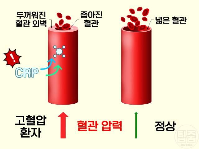 혈압 낮추는 법 다이어트 비만 고혈압 상관관계 염증성단백질 crp
