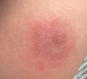 모기 물려서 가려울 때