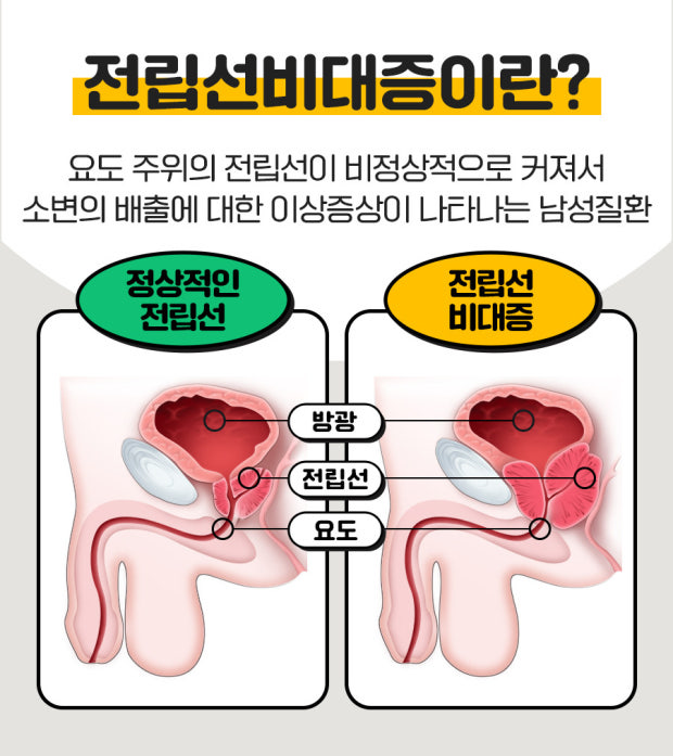 전립선 비대증의 증상 및 원인, 치료방법