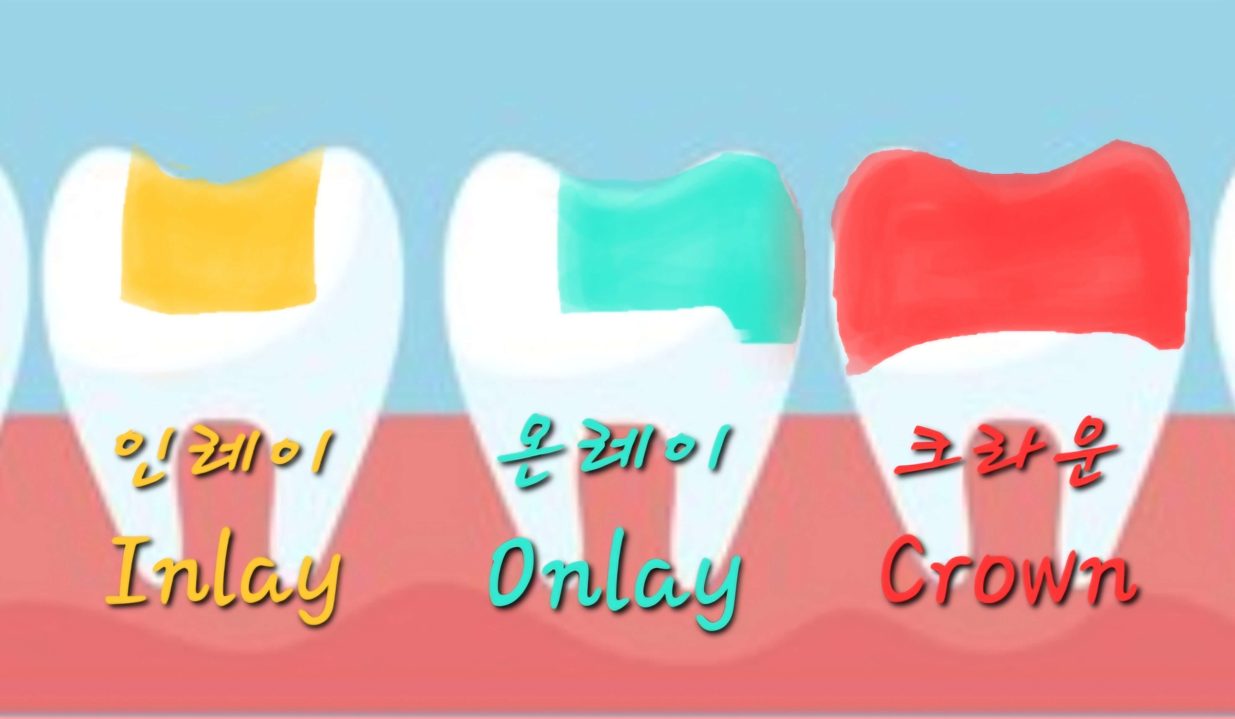 인레이 온레이 크라운 사진