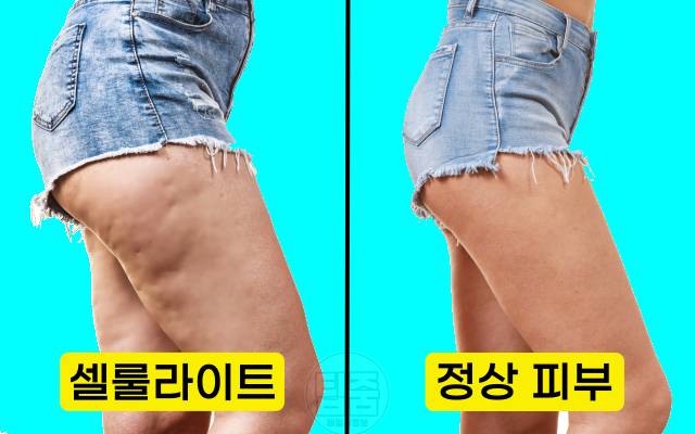 셀룰라이트 제거 음식 셀룰라이트 없애는 음식
