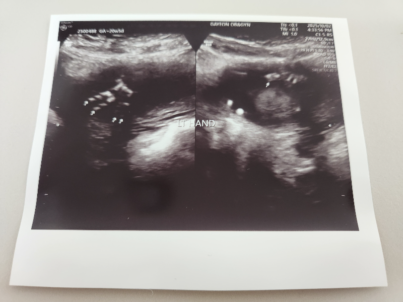 2차 정밀 초음파