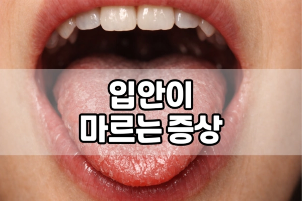 입안이 마르는 증상