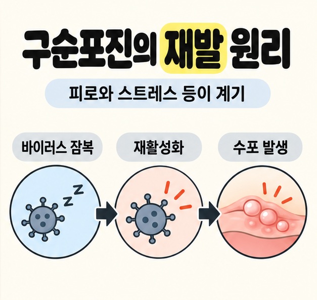 피로와 스트레스 등이 계기가 될 수 있다는 안내 아래 바이러스 잠복에서 재활성화를 거쳐 수포 발생으로 이어지는 구순포진 재발 개념도