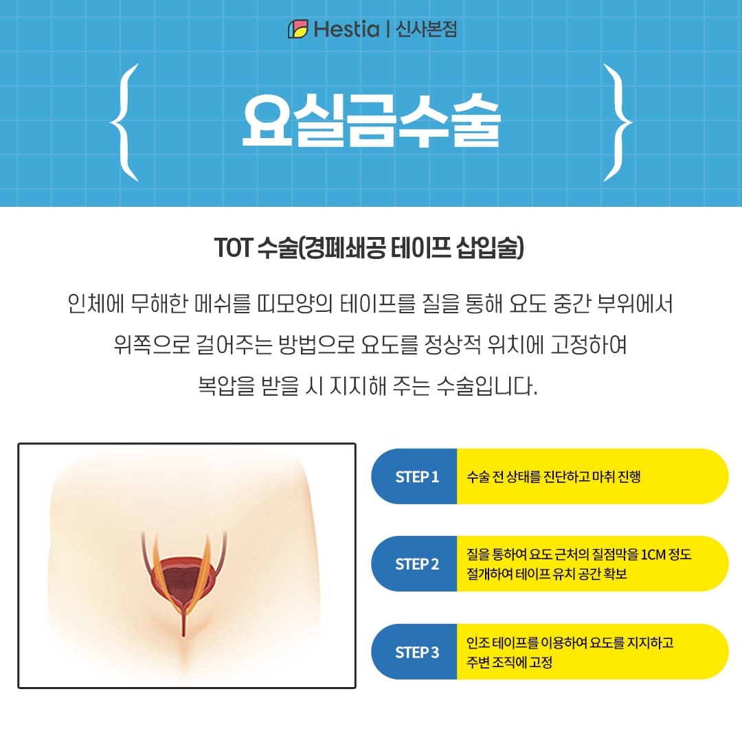 요실금 수술, 무엇을 알아야 할까?