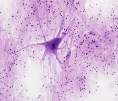 대상포진 후 신경통 증상 원인 치료 방법