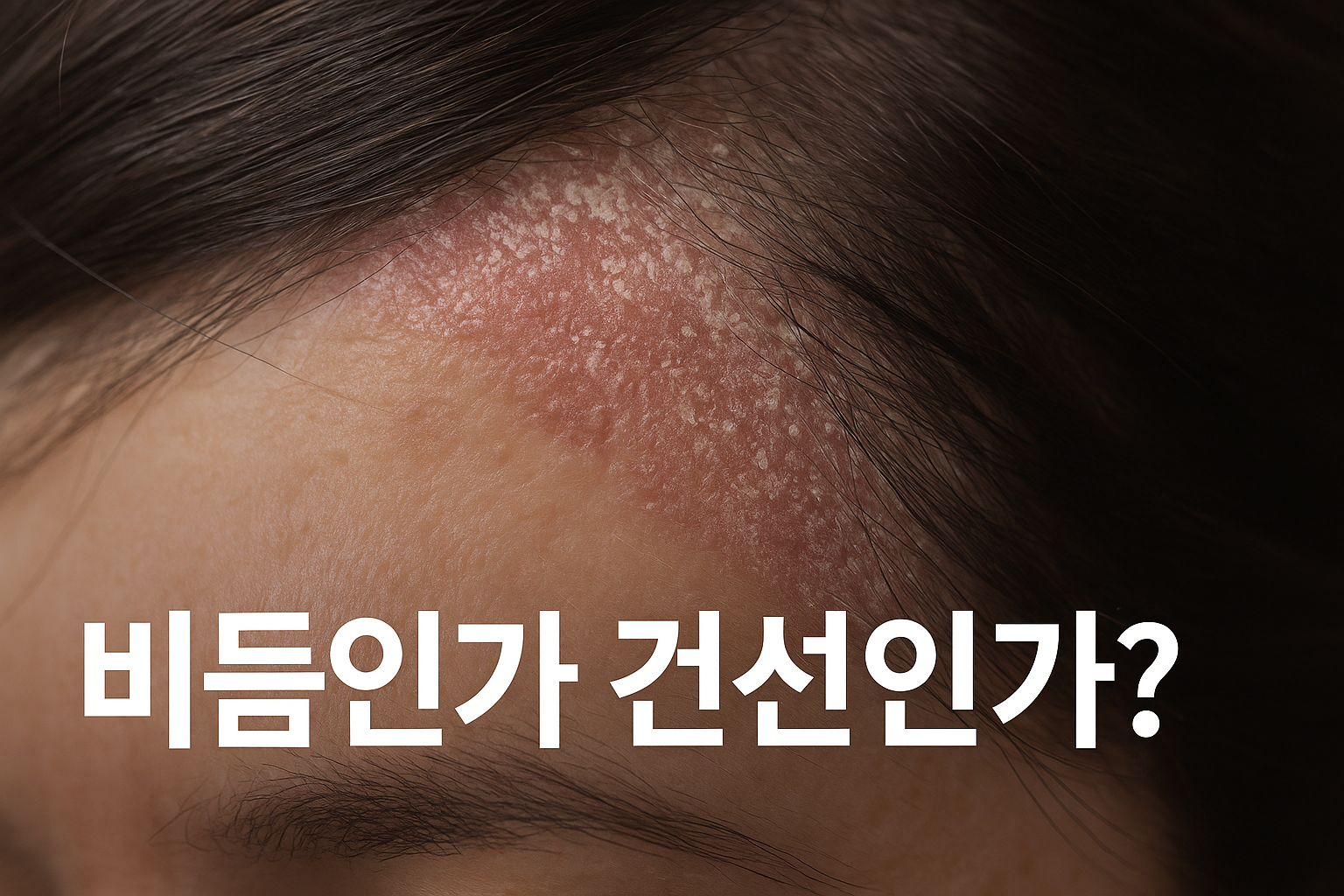 두피 건선 완전 가이드