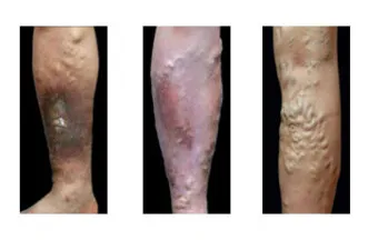 하지 정맥류 증상 치료방법과 예방 생활습관_19