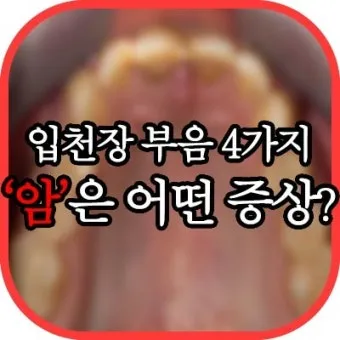 입천장 헐었을 때 면역력 저하 관련 증상과 영양 관리법_9