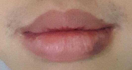 입술 축소수술 후기