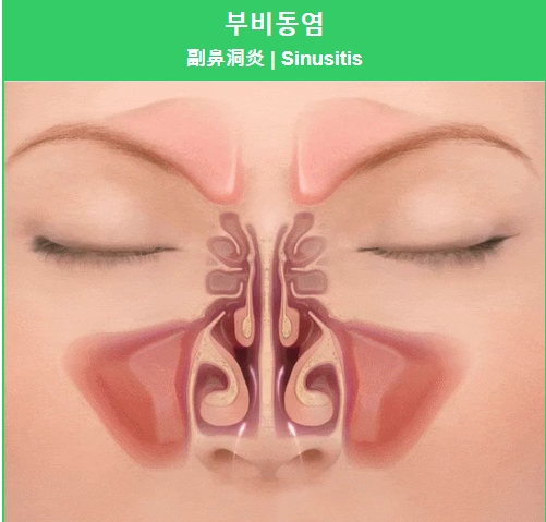 부비동염