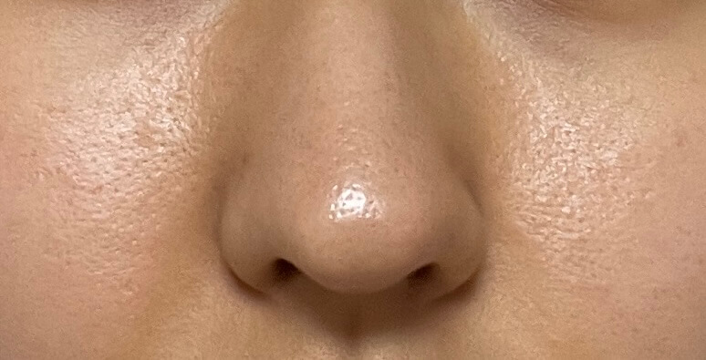 성분에디터 그린토마토 모공앰플 사용후기(2주차&amp;#44; 6주차 비교사진)