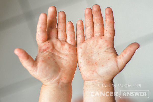 수족구병 증상 원인 치료 전염 수포 잠복기