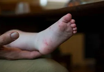 수족구 초기 증상 어른 감염 격리기간 예방 치료 완전 가이드_6