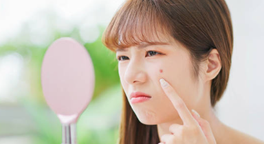 여드름 흉터