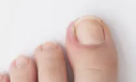 발가락 통증