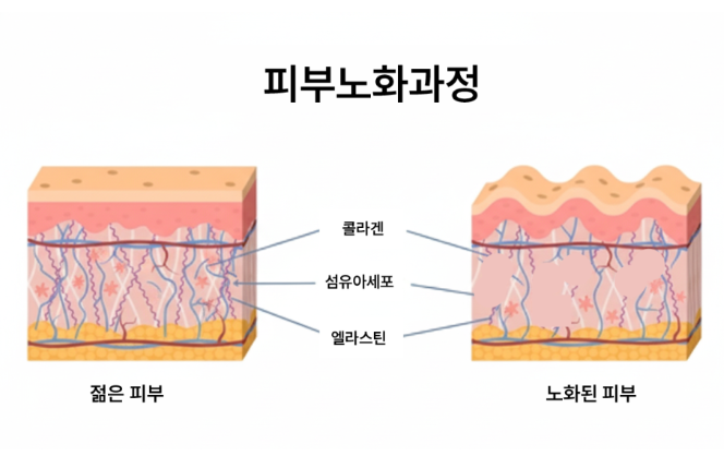 압구정실리프팅, 처진얼굴리프팅