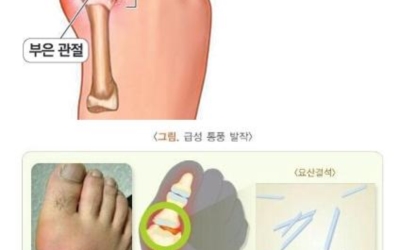 통풍이미지