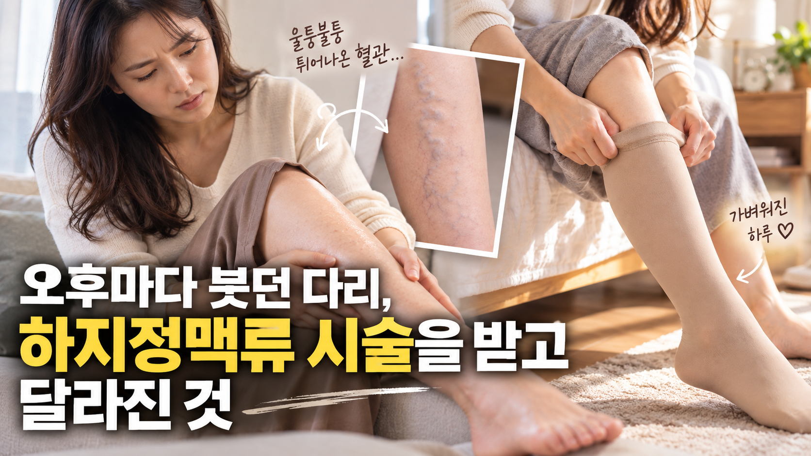 하지정맥류