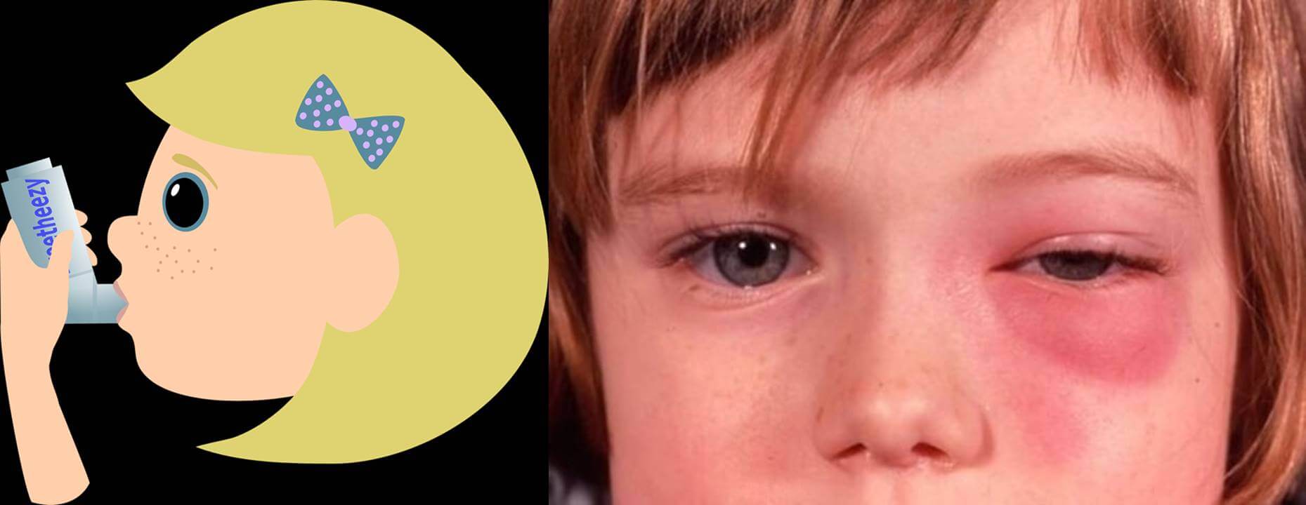 부비동염-원인-증상-치료-예방-방치하면-합병증으로