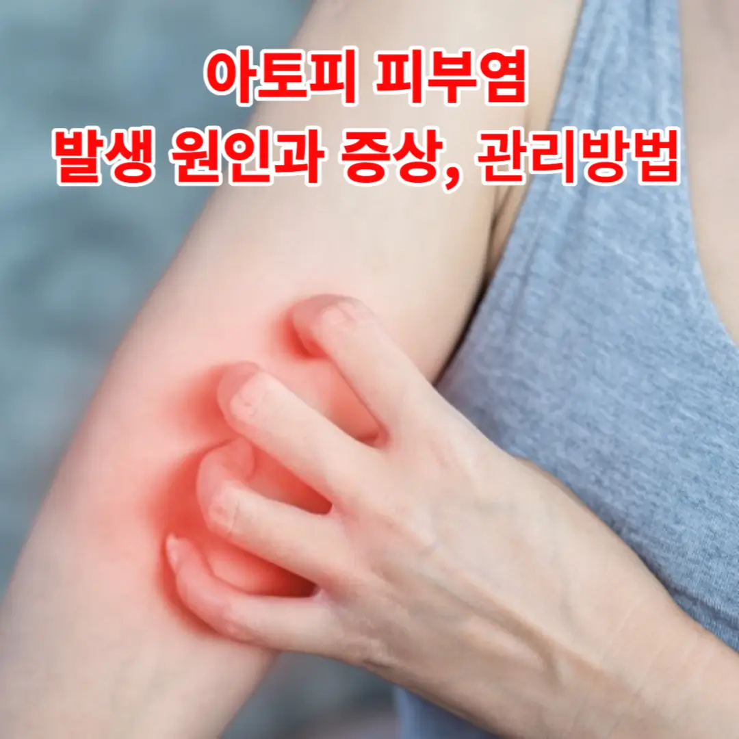 아토피 피부염(Atopic Dermatitis): 발생 원인과 증상 그리고 관리방법