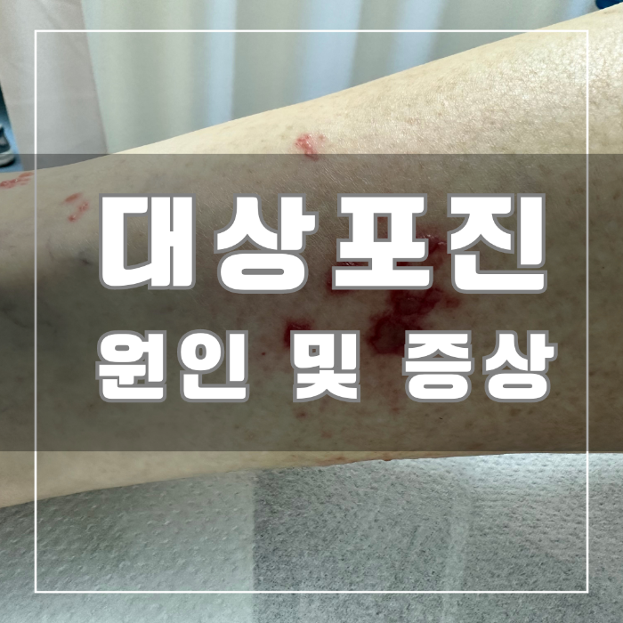 대상포진 원인 및 증상