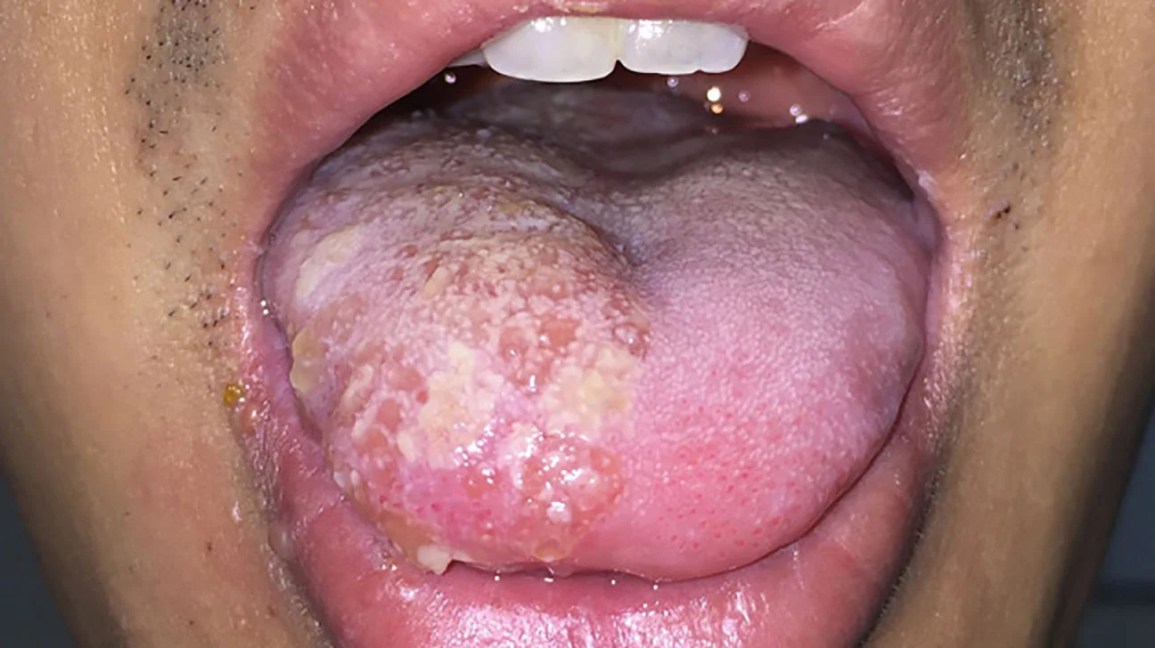 바이러스에 감염된 입