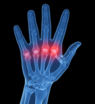 손가락 마디 아픈 이유 5가지2