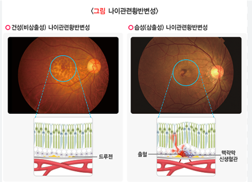 황반변성