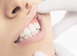 잇몸에 하얀 종기