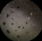 망막 박리 증상