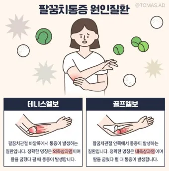 팔꿈치 통증 원인 6가지증상운동법예방법치료법까지_4