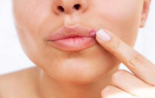 헤르페스 2형 증상