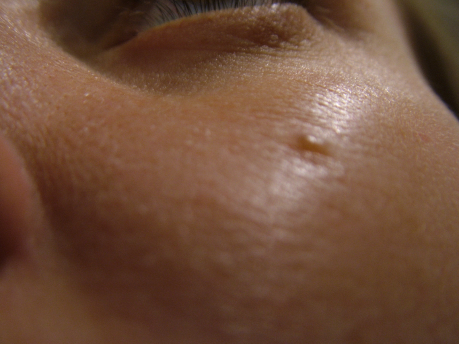 모낭염 여드름 사진