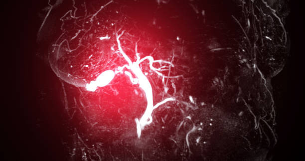 담낭염의 증상, 원인, 치료