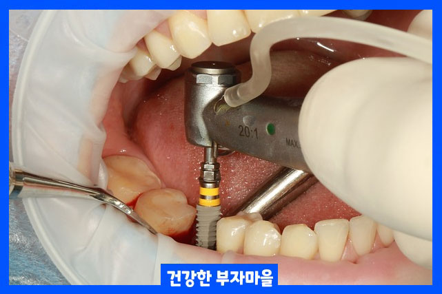 임플란트 수명 얼마나 오래 유지될까