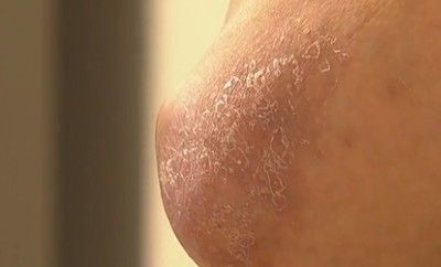 건선 초기 증상