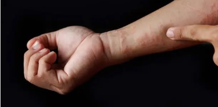 아토피 관련 사진