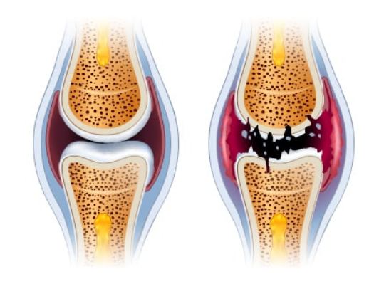 글루코사민 효능, 부작용, 복용법, 추천 상품