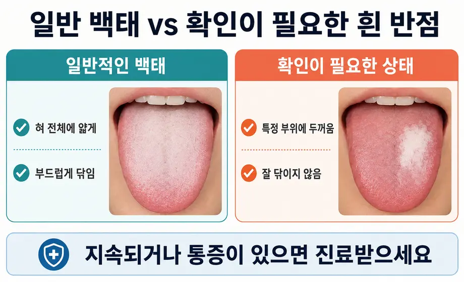 일반적인 백태와 진료 확인이 필요한 혀의 흰 반점 차이 비교