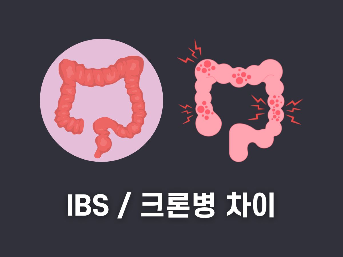 과민성대장증후군 크론병 차이