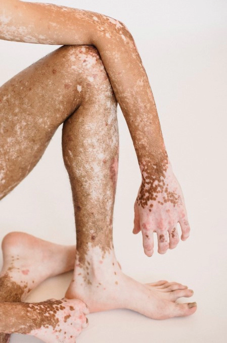 백반증 초기증상